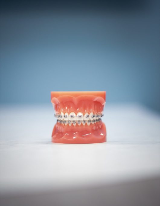 Hentscher Johnson Orthodontics Columbia Illinois Types of Orthodontic Braces 19 530x680 - Self-Ligating Braces