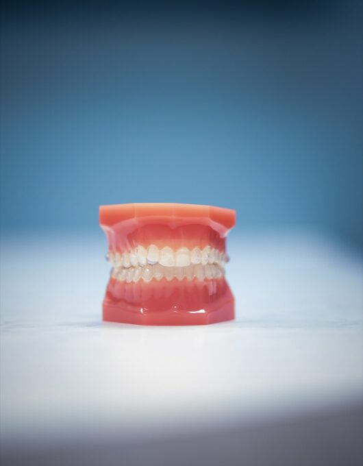Hentscher Johnson Orthodontics Columbia Illinois Types of Orthodontic Braces 2 530x680 - Angel Aligners