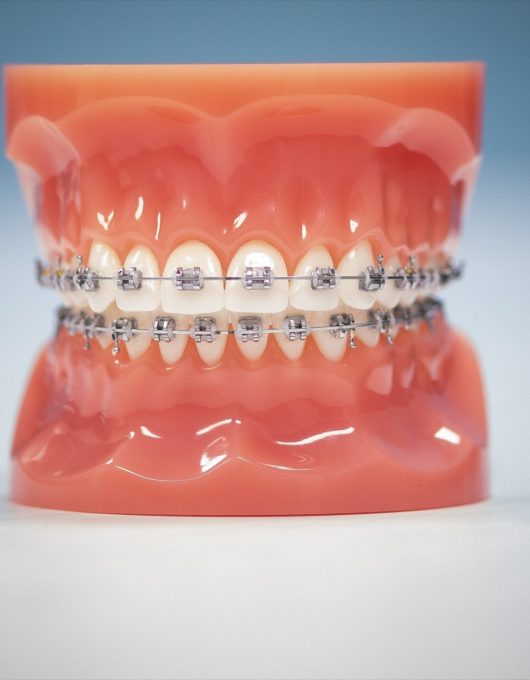 Hentscher Johnson Orthodontics Columbia Illinois Types of Orthodontic Braces 21 530x680 - Self-Ligating Braces