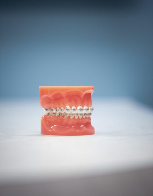 Hentscher Johnson Orthodontics Columbia Illinois Types of Orthodontic Braces 23 530x680 - Self-Ligating Braces