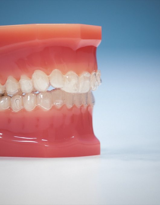 Hentscher Johnson Orthodontics Columbia Illinois Types of Orthodontic Braces 4 530x680 - Clear Aligners