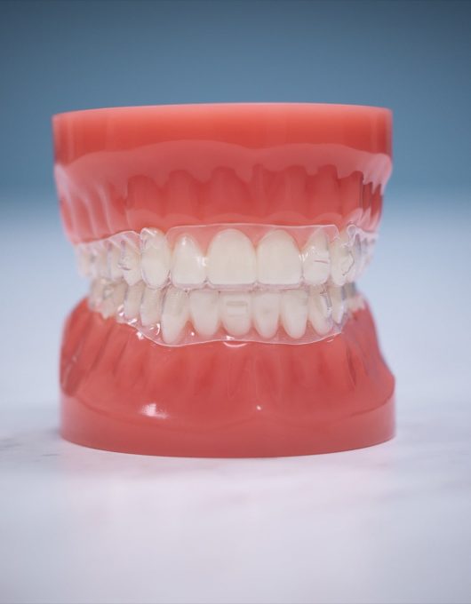 Hentscher Johnson Orthodontics Columbia Illinois Types of Orthodontic Braces 52 530x680 - Clear Aligners