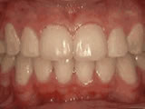 crowding of the teeth after - Common Treatments