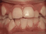 crowding of the teeth before - Common Treatments