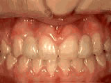 missing lateral incisors after - Common Treatments