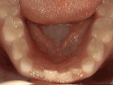 non braces treatment before - Common Treatments