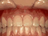 openbite after - Common Treatments