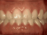 spacing of teeth after - Common Treatments