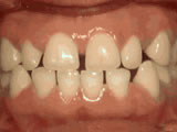 spacing of teeth before - Common Treatments