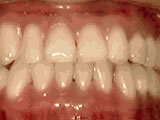 underbite after - Common Treatments