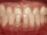 underbite before - Common Treatments